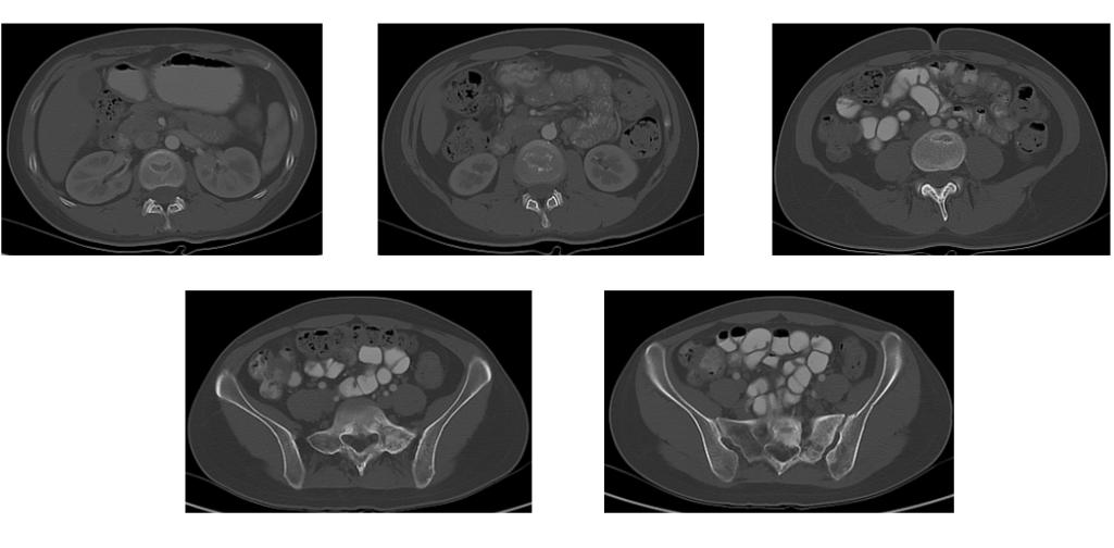 曲妥珠单抗副作用几天消失,曲妥珠单抗联合帕妥珠单抗