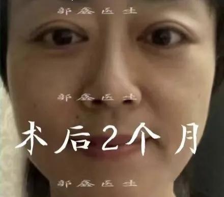 北京做眼袋手术大概需要多少钱,到正规大医院做眼袋手术有风险吗