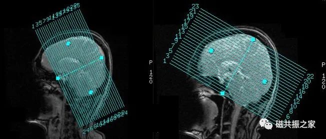 头颅mri的操作步骤,头颅平扫mri能查出什么病