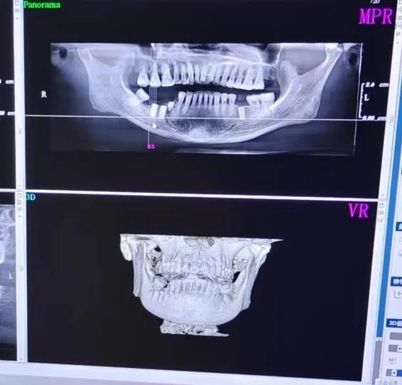 一个牙医的良心忠告种植牙,种牙戴牙冠5年后真实感受