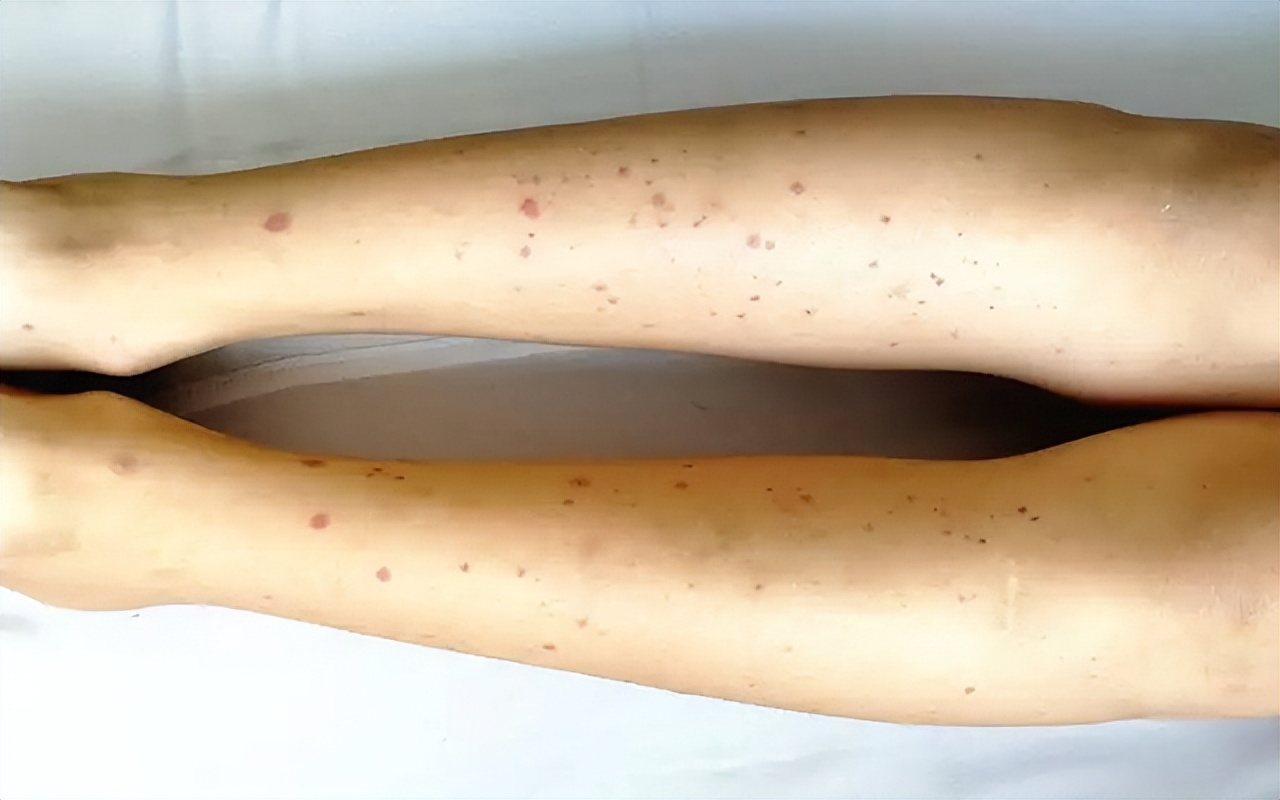 针尖似的过敏性紫癜用治疗吗,为什么出现紫癜