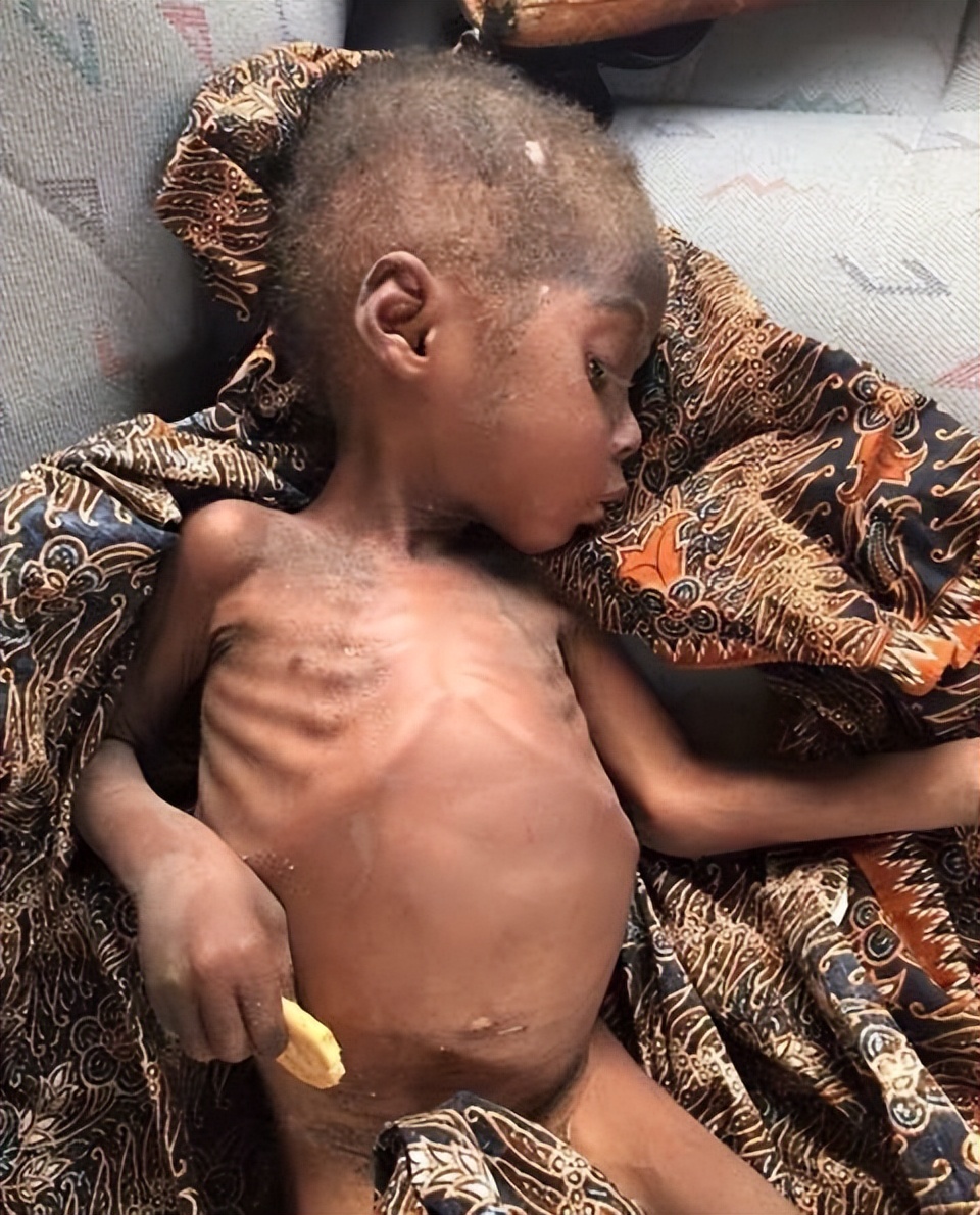 2013年，非洲2岁“巫童”遭父母遗弃，饿得皮包骨，如今还活着吗