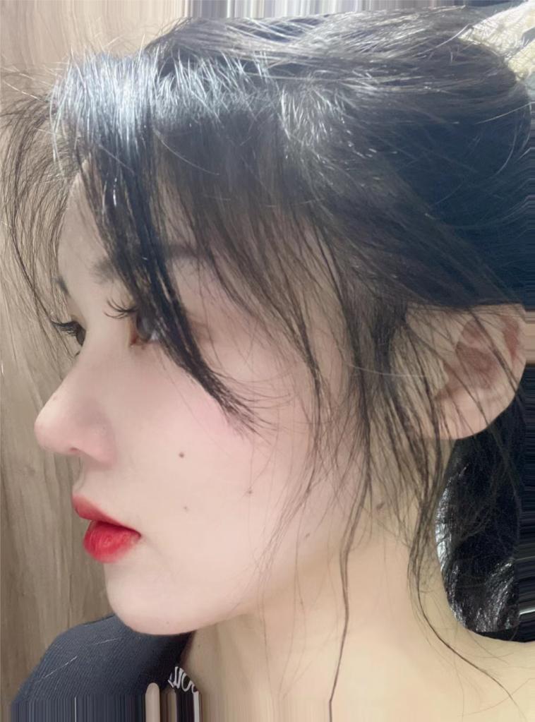 玻尿酸线雕隆鼻照片,做过线雕鼻的鼻子