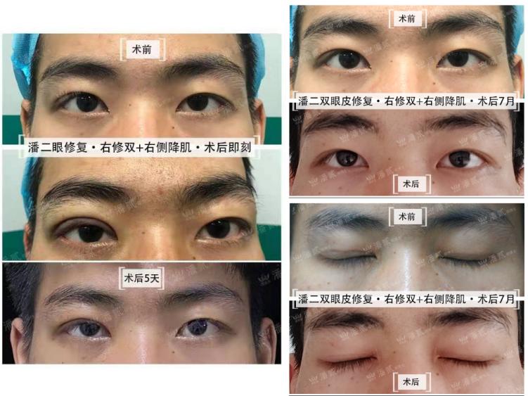 男士割双眼皮恢复全过程,男士割双眼皮手术