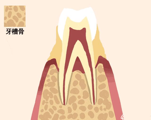 严重的牙石清除小窍门牙周炎,牙周炎应该如何养护牙齿