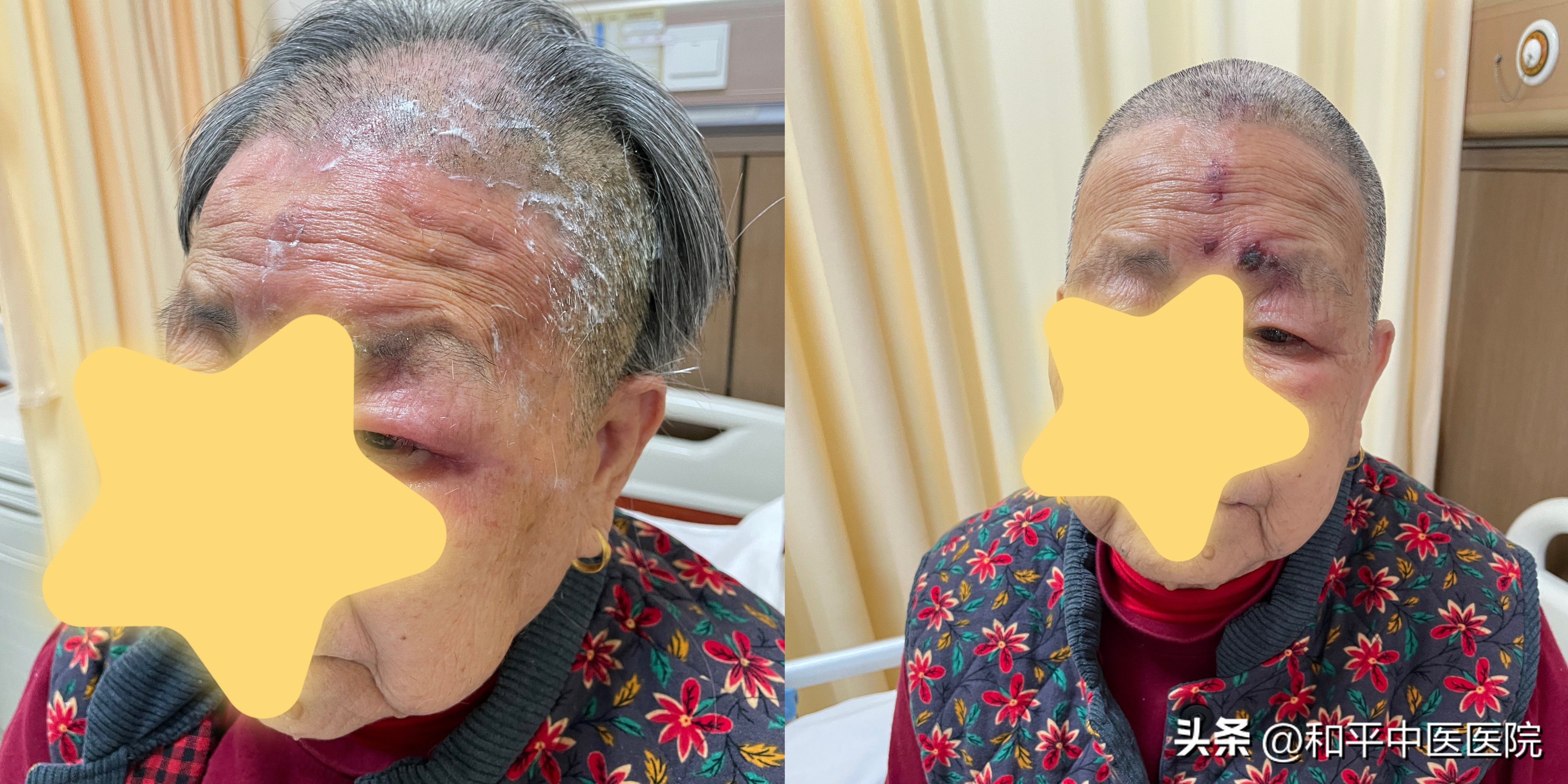 上头！长在这里的带状疱疹真的很危险！