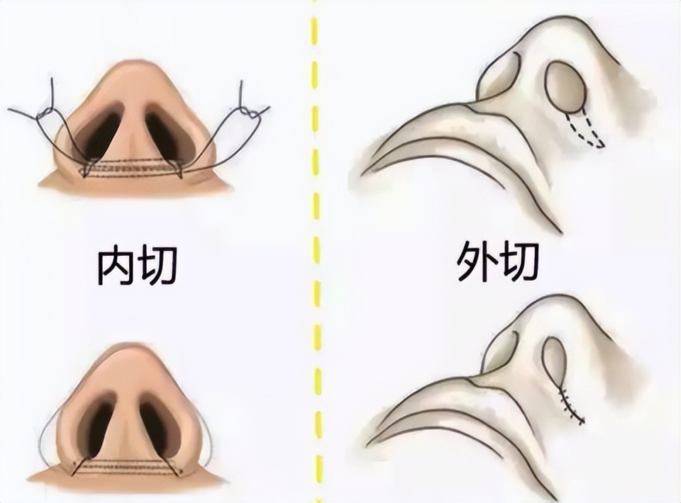 鼻孔大鼻翼大怎么缩小,鼻翼缘退缩矫正后鼻孔变大