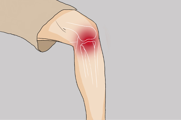 半月板磨损膝盖疼痛如何治疗,膝盖疼痛半月板磨损一招解决