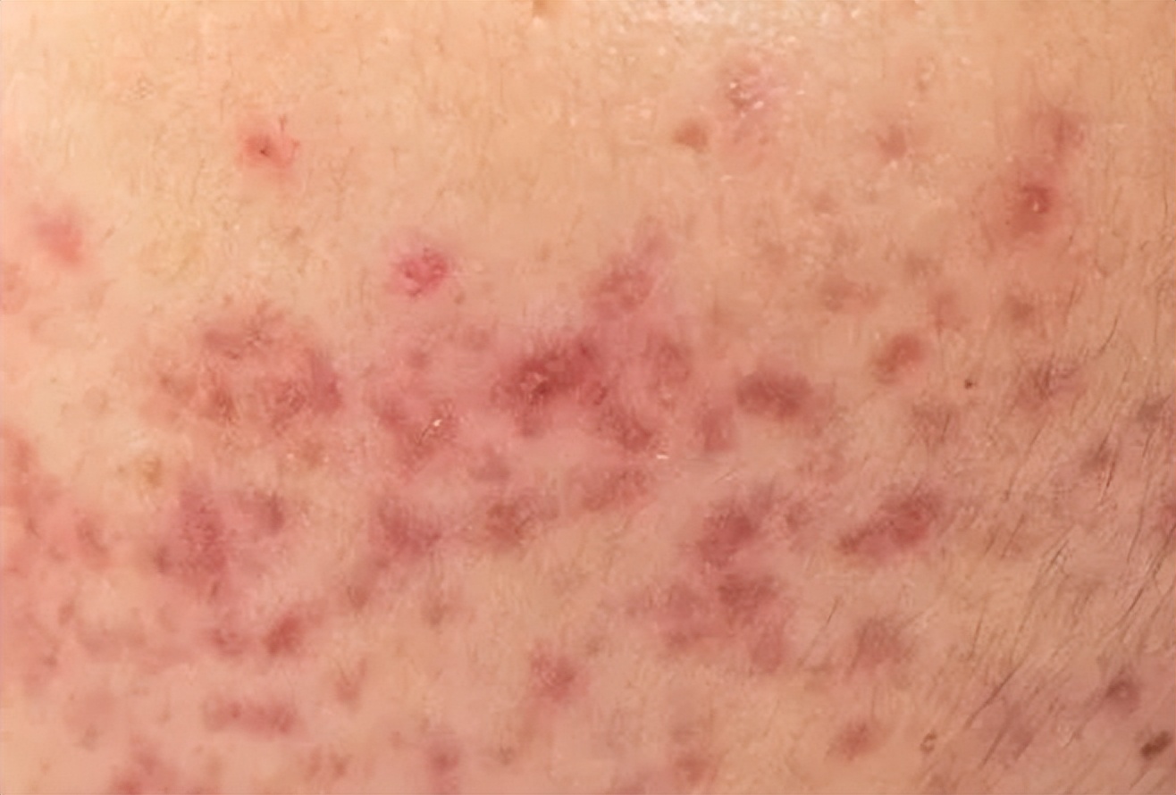 阿莫西林别乱吃只对这四种病有效,阿莫西林十大禁忌