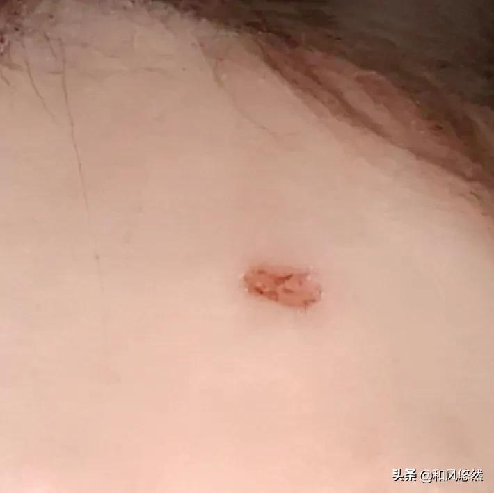 祛斑真实有效推荐,快速祛斑易出现哪些副作用