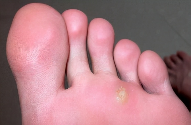 鸡眼跖疣老茧如何区分,修脚去鸡眼跖疣死皮老茧