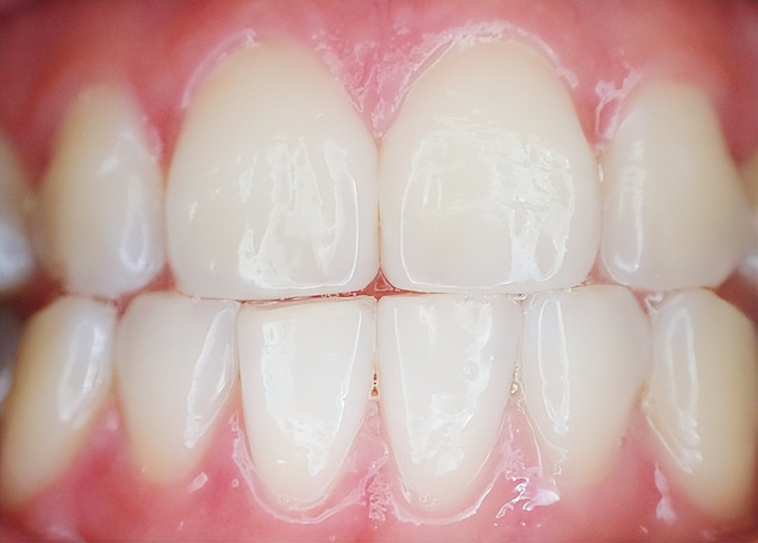 吃饭总咬腮帮是怎么回事儿,吃饭总咬腮帮子是缺啥