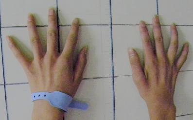 手腕无力手指笨拙虎口萎缩,手臂手掌无力萎缩的症状