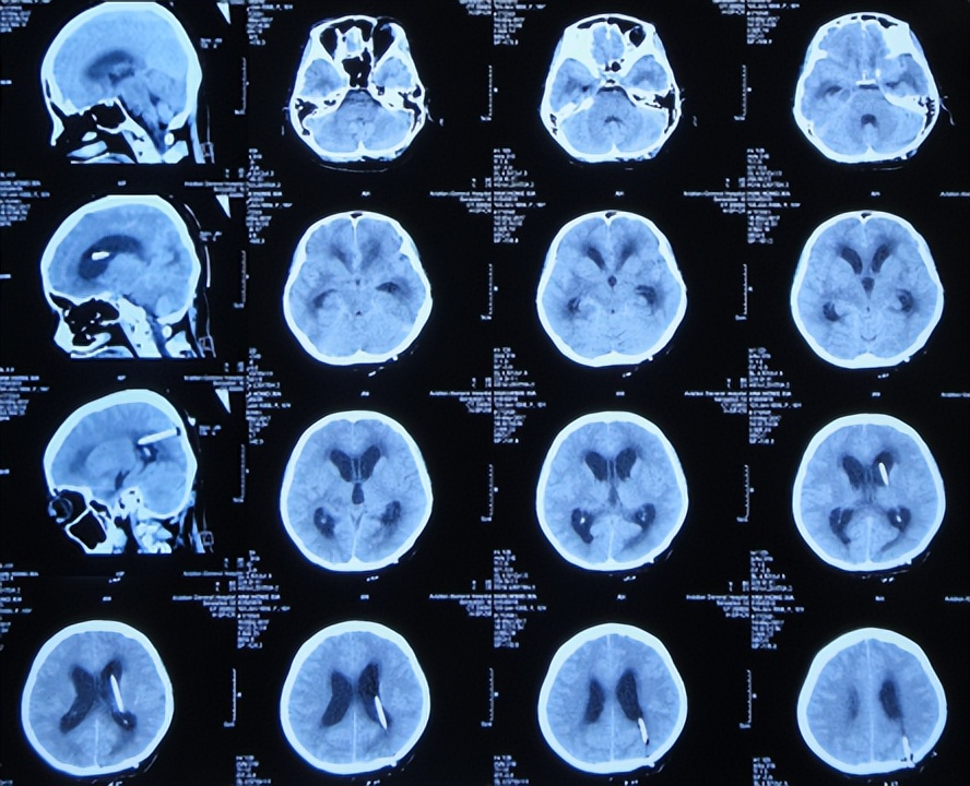 结核脑炎型脑积水怎么治,结核性脑膜炎2期很严重吗