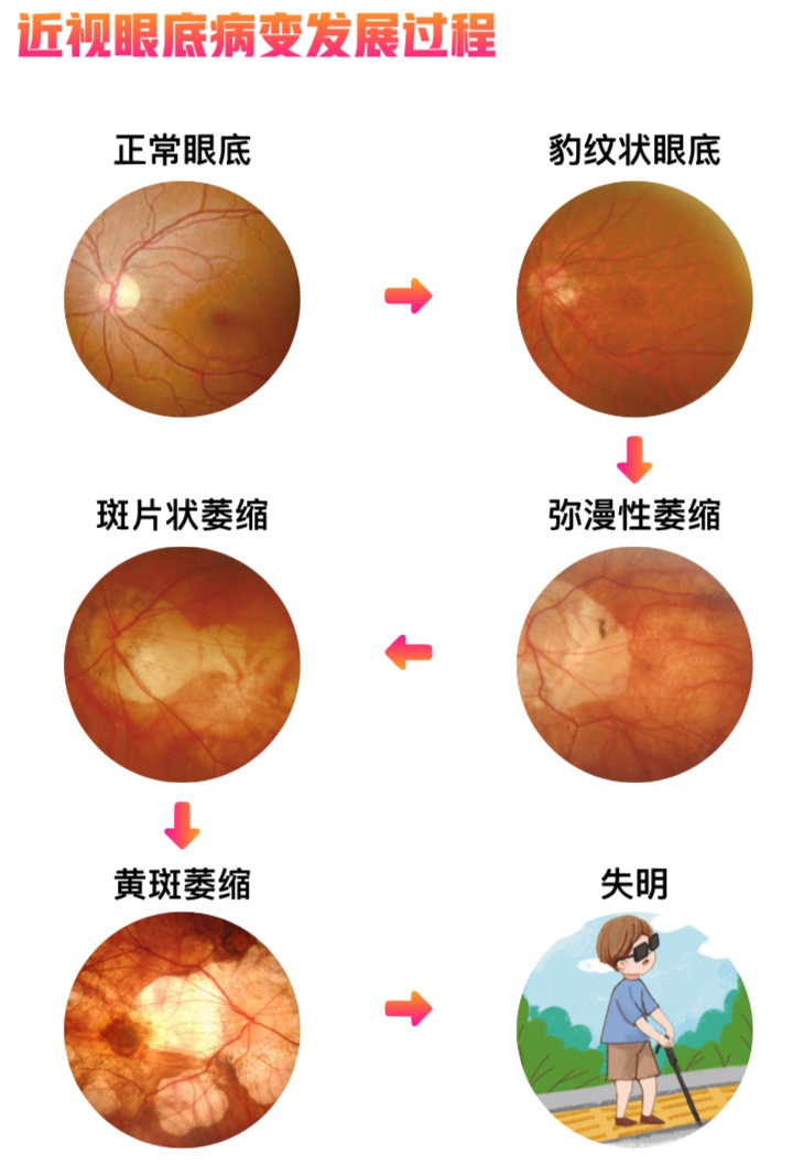 超高度近视阿姨,高度近视阿姨