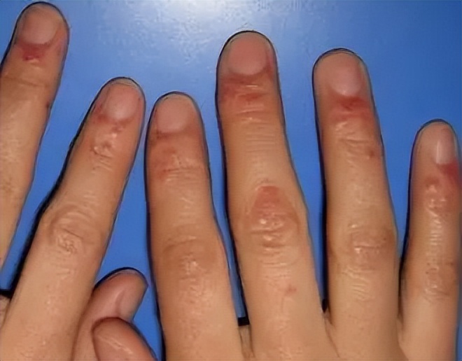 湿疹难耐远离湿疹从这四点做起,湿疹瘙痒难忍找对方法很重要