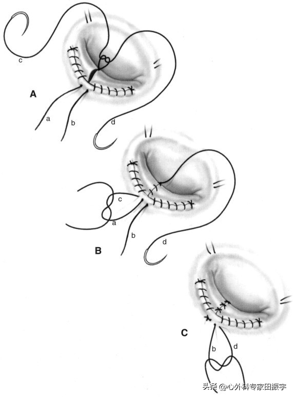二尖瓣成形术要多少钱,二尖瓣成形术后抗凝多久