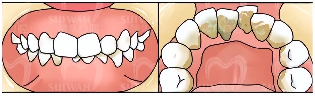 吃东西老是塞牙缝怎么解决,吃东西经常塞牙齿