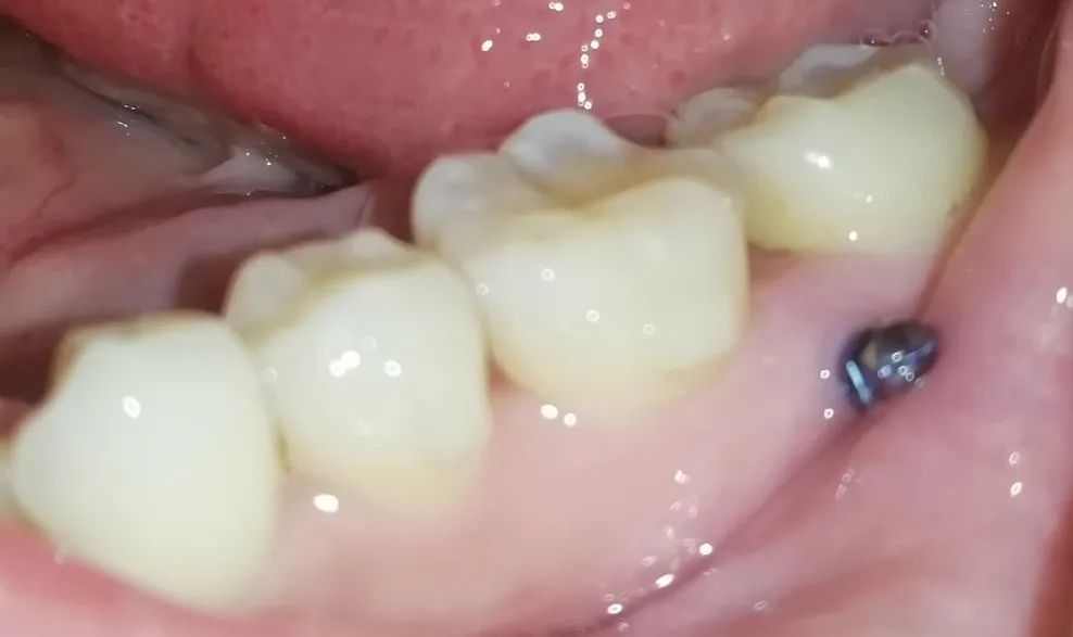 整牙亲身经历分享一下,整牙的经历分享