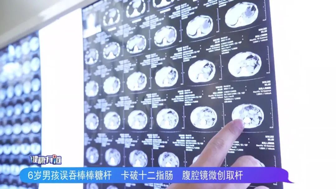 宝宝误吞棒棒糖棍后能自己排出吗,孩子把棒棒糖杆吞肚子里了该咋办