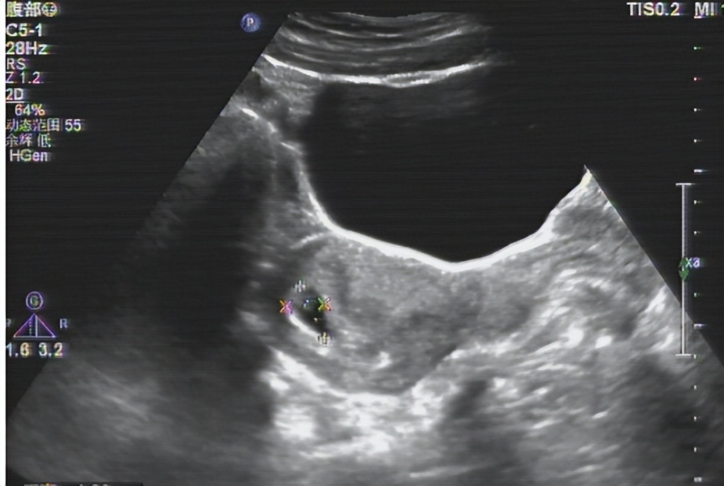 备孕很久却一直怀不上做什么检查,备孕很久了一直怀不上怎么回事