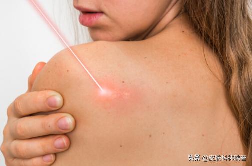 脸上点痣留下很明显的红印怎么办,脸上点痣后的疤痕怎么处理