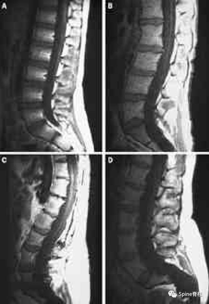 硬膜扩张,duralectasia