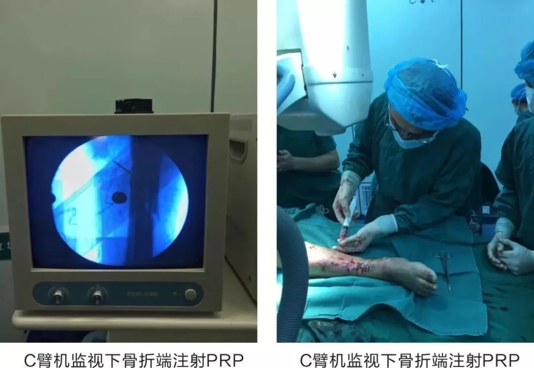 关节prp治疗要打麻药吗,风湿性关节炎prp