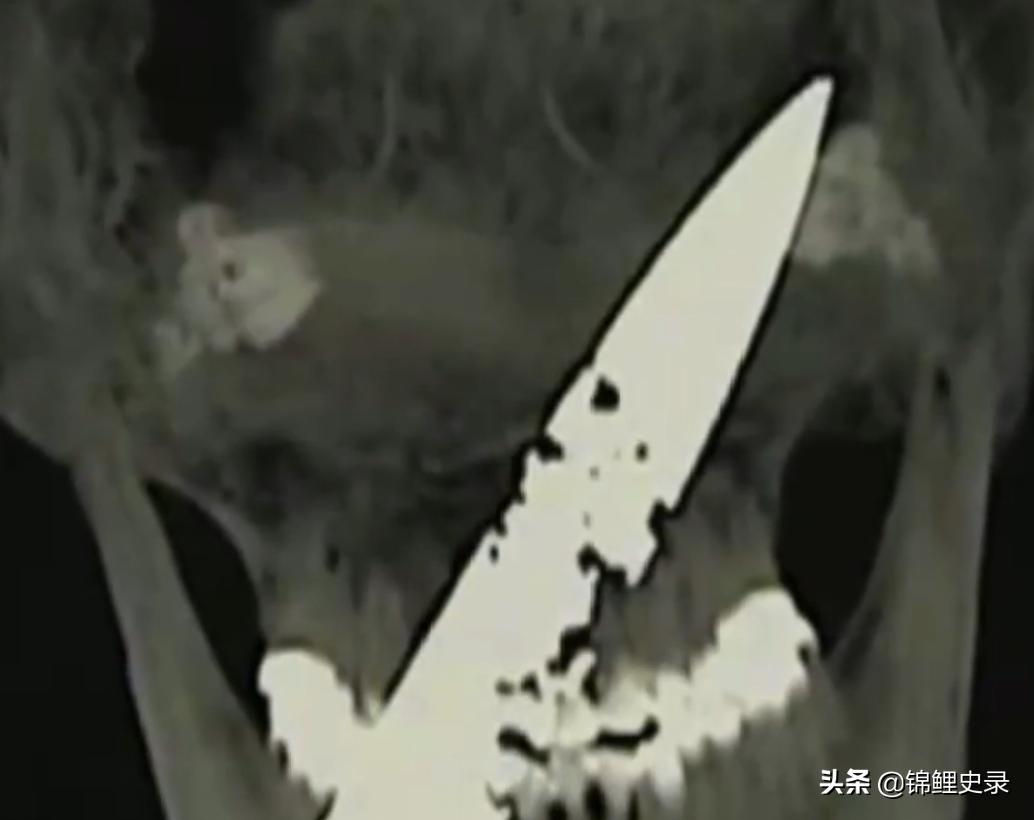 云南男子口臭骇人医生检查惊呼,云南男子口臭传奇故事