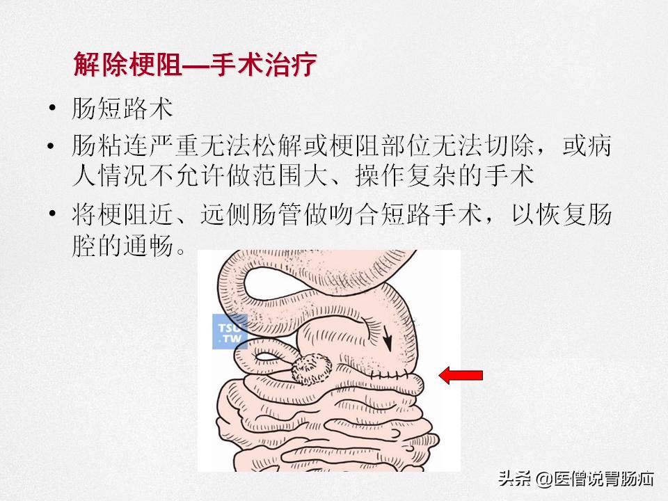 肠梗阻健康教育,肠梗阻患者的健康宣教