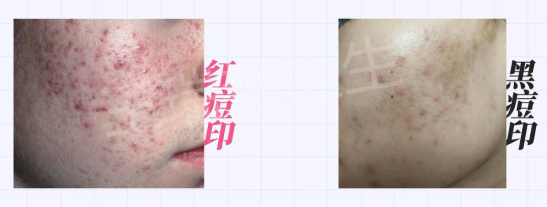 怎么区分不同种的痘痘,如何分清自己的痘痘是什么类型