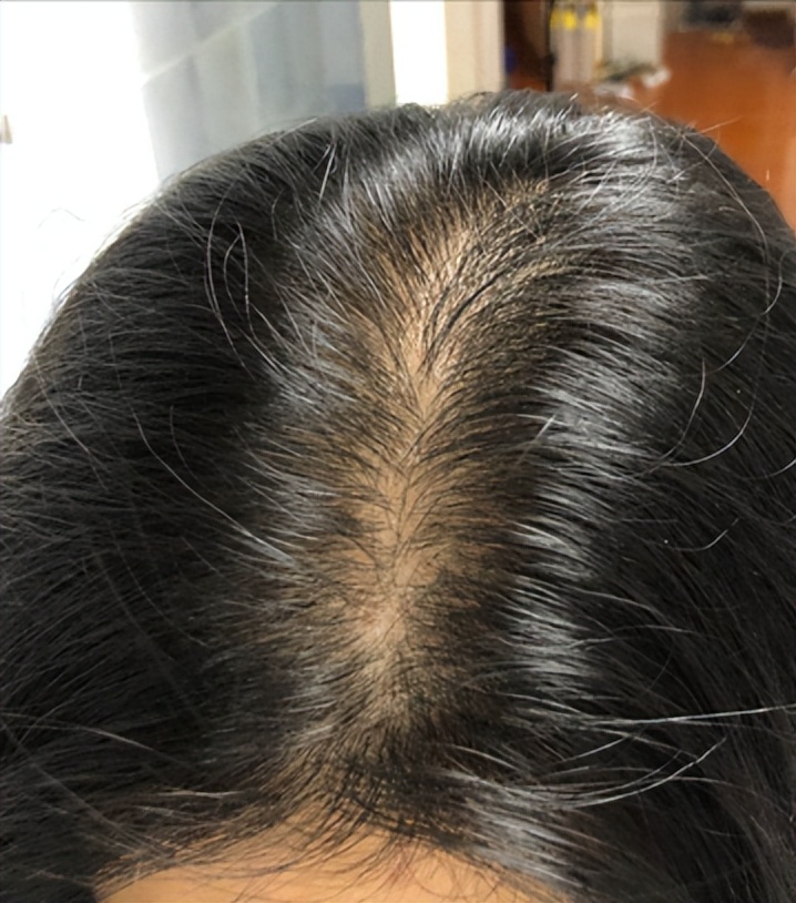 米诺地尔长头发的原理,用米诺地尔能长头发吗