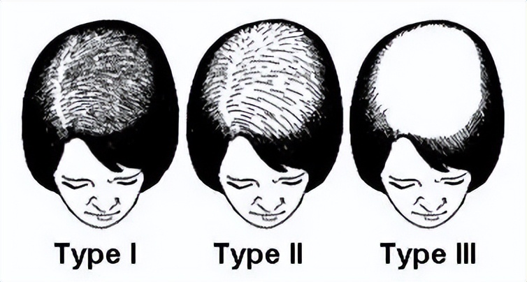 失眠头发掉得厉害是什么原因,秋天头发掉得厉害是什么原因