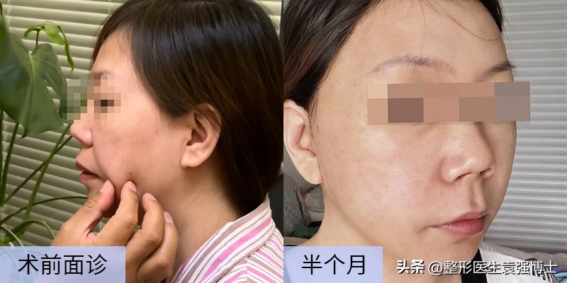 拉皮不剥离会留疤明显吗,拉皮手术如何防止留疤