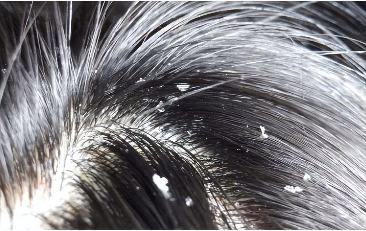 头皮上经常长脓包,头皮经常起疙瘩有脓包是什么原因