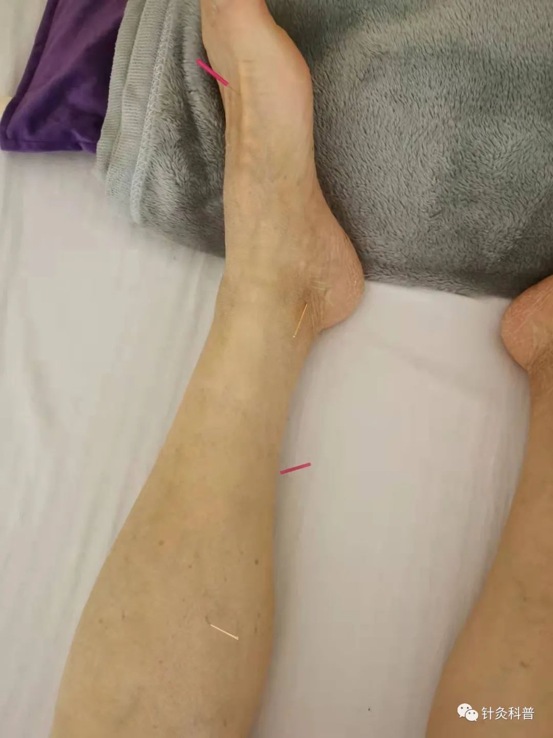 脉诊针灸穴位,董氏针灸治疗青光眼处方