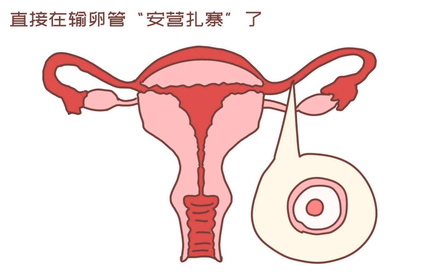 盆腔积液=盆腔炎？不要被它吓破了胆，范主任给你讲清楚、调正常