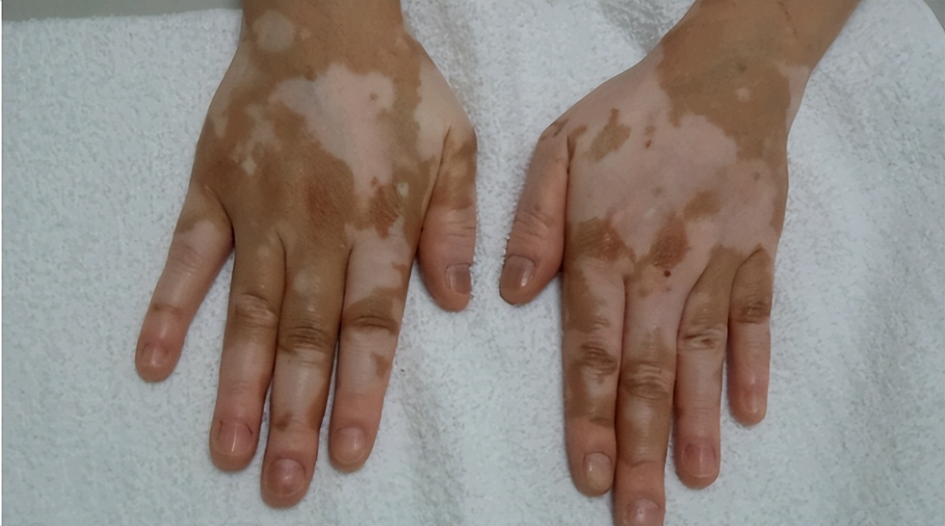 白癜风植皮手术恢复图片,白癜风植皮费用大概多钱