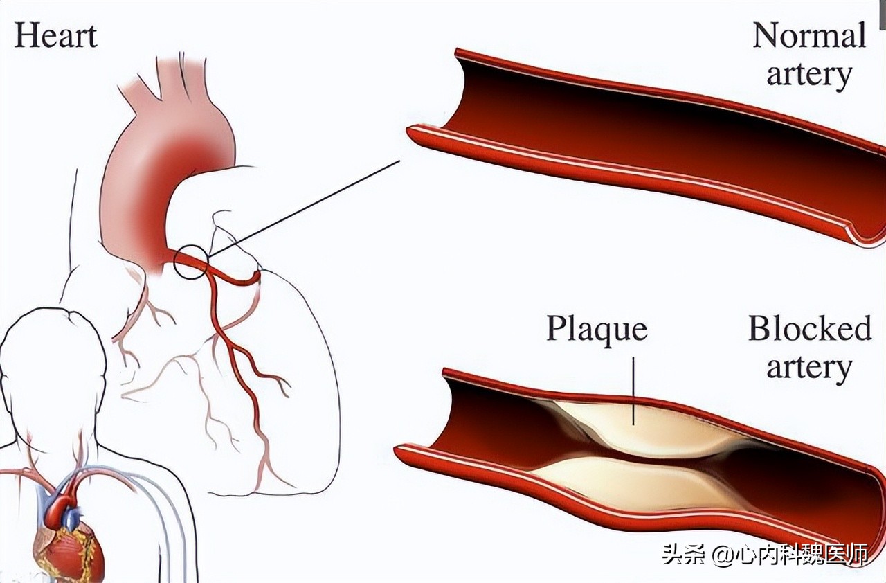男性可以吃叶酸预防心脑血管疾病,男性补充叶酸对精子的影响