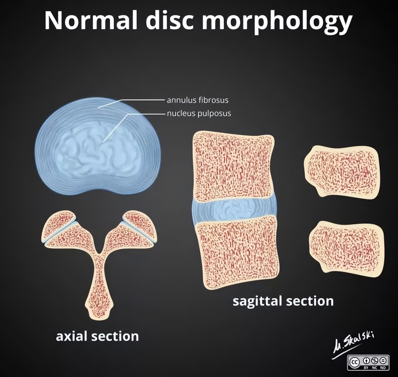 椎间盘突出膨出脱出如何治疗最好,椎间盘突出图怎么看