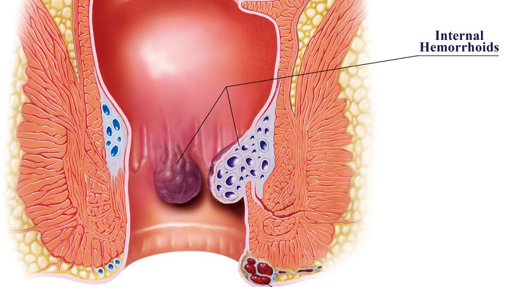 消痔汤真的能消痔吗,消痔汤治疗内痔可以吗