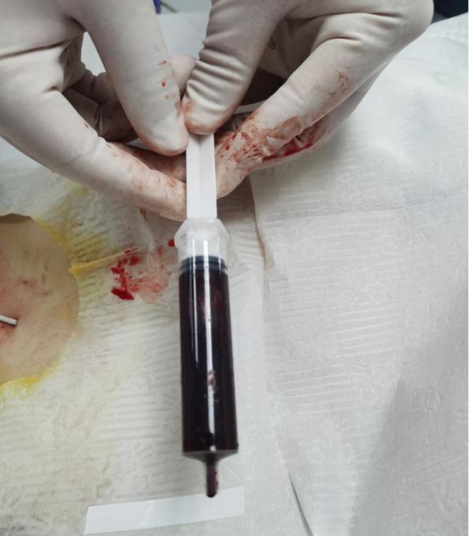 急性肾衰竭血肌酐一直升高,慢性肾功能衰竭肌酐高