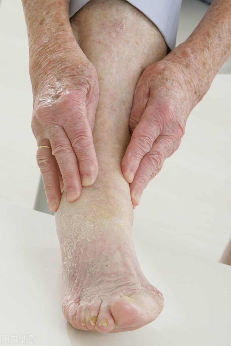 糖尿病引起的类风湿关节炎怎么办,糖尿病会引起骨性关节炎吗