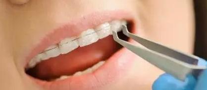 明明很小心却还是出问题,托槽如果频繁掉有哪些方案