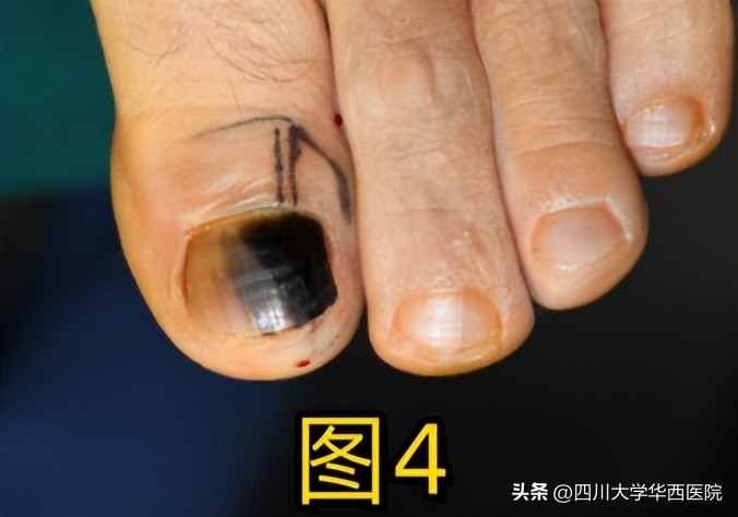 华西专家说，不是转你们，起码有一半的人从没有剪对过指甲儿！