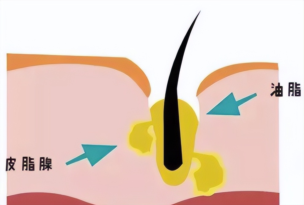 油光满面毛孔粗大是什么原因,鼻子两侧毛孔粗大是什么原因