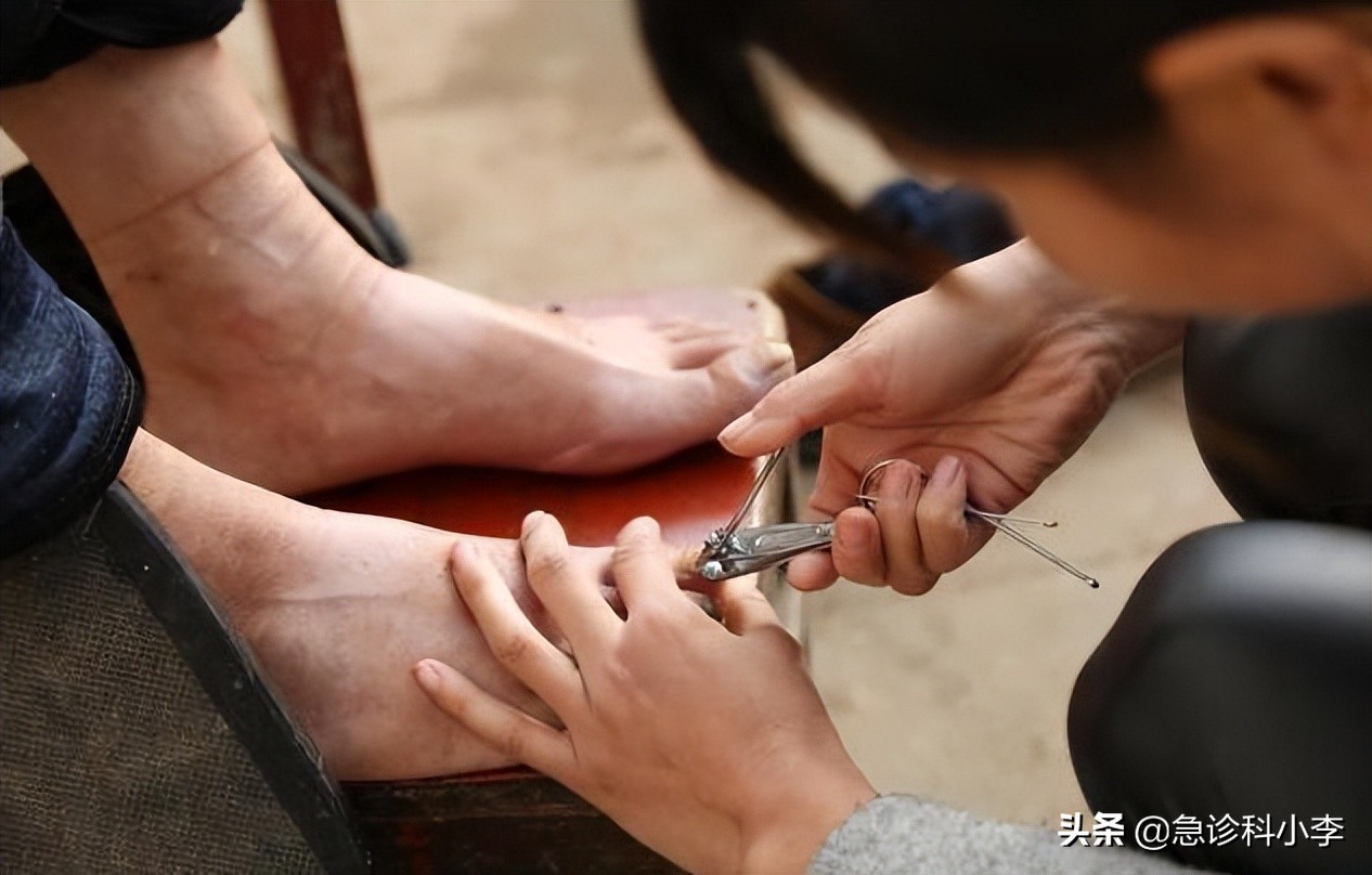 脚趾甲老往肉里钻,脚趾甲总是往肉里钻怎么办