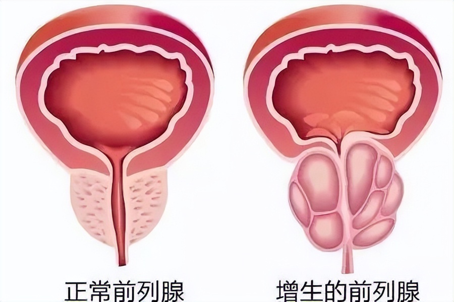 尿频尿急真的看不好吗,尿频尿急夜尿多千万别轻视