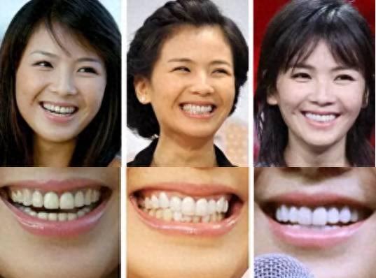 明星烤瓷牙发黑,明星烤瓷牙牙齿磨小后照片