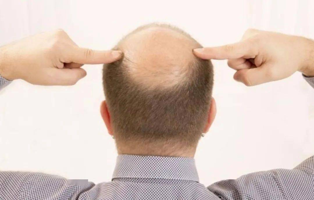 中年头发稀疏用什么药可恢复,头发稀疏的补救方法16岁